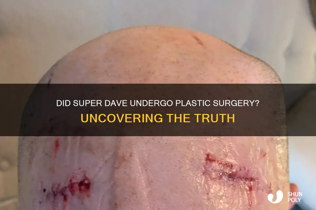 did super dave get plastic surgery