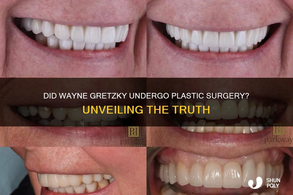 did wayne gretzky get plastic surgery