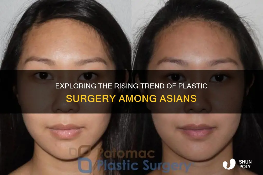 do asians get plastic sergury