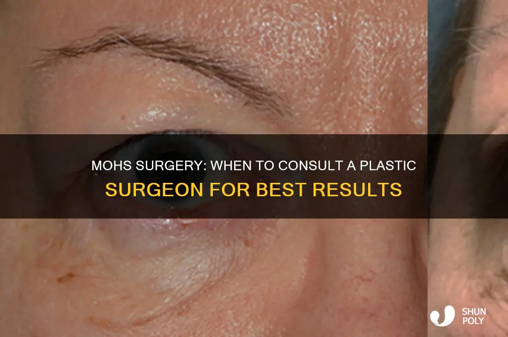 Mohs Surgery When To Consult A Plastic Surgeon For Best Results ShunPoly mohs-surgery-when-to-consult-a-plastic-surgeon-for-best-results-shunpoly