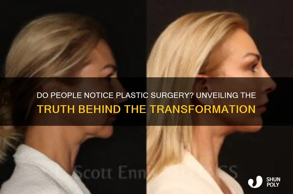 do people notice plastic surgery