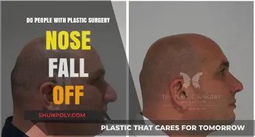 Plastic Surgery Nose: Debunking the Myth of Falling Off