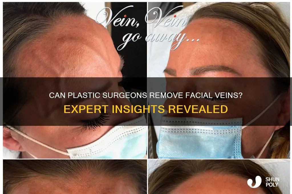 do plastic surgeons remove facial veins