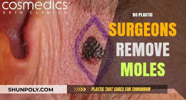 Do Plastic Surgeons Remove Moles? Expert Insights and Procedures