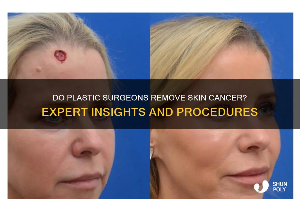 do plastic surgeons remove skin cancer