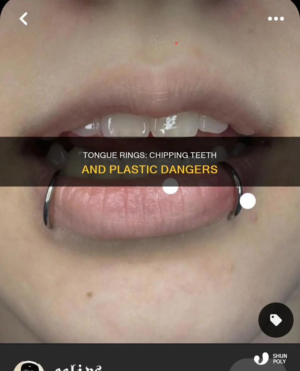do plastic tongue rings chip teeth