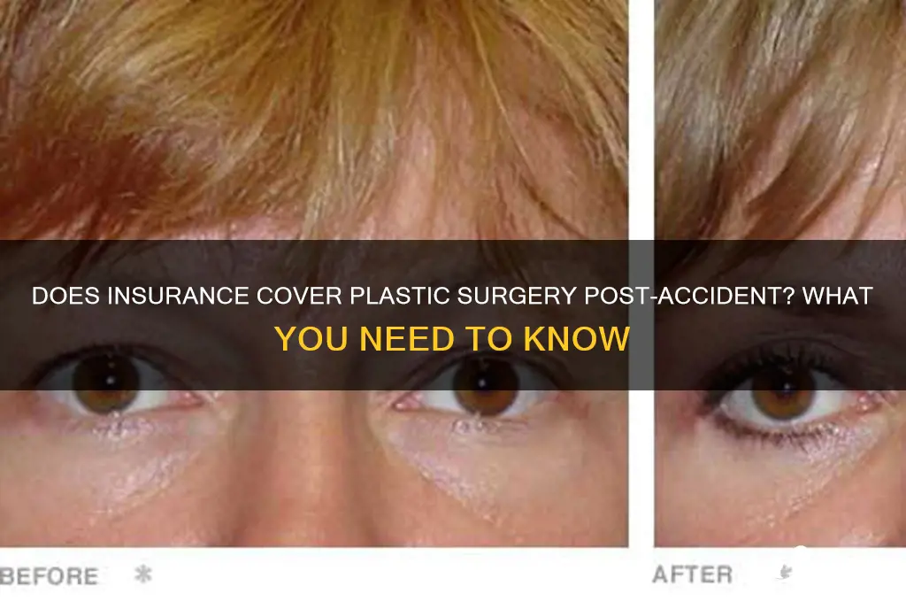 does insurance cover plastic surgery after accident