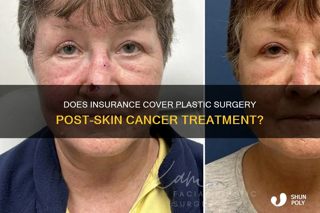 does insurance cover plastic surgery after skin cancer