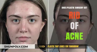 Can Plastic Surgery Permanently Eliminate Acne? Exploring the Facts