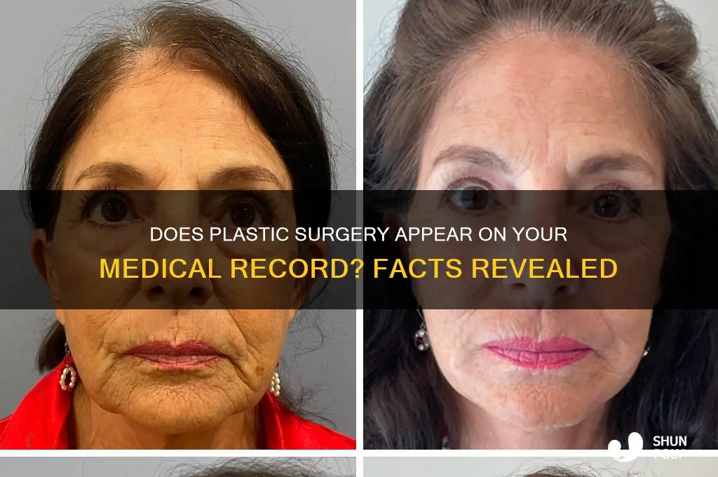 does plastic surgery go on your medical record