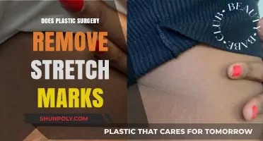 Can Plastic Surgery Effectively Eliminate Stretch Marks? Expert Insights
