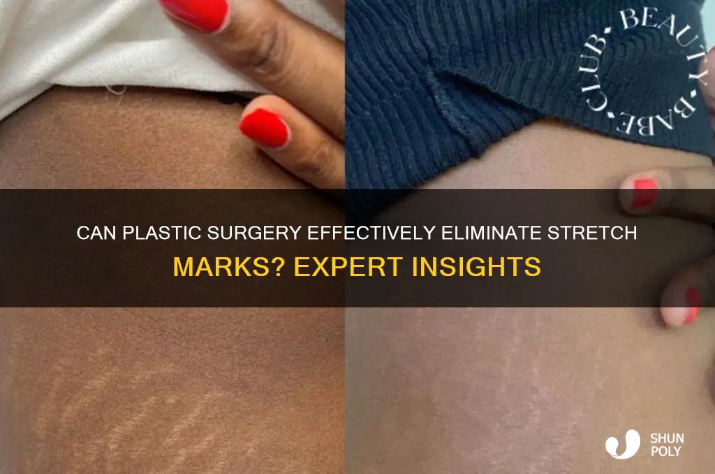 does plastic surgery remove stretch marks