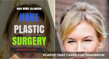 Renee Zellweger's Transformation: Plastic Surgery Speculations and Truths