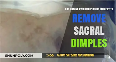 Sacral Dimple Removal: Exploring Plastic Surgery Options and Experiences