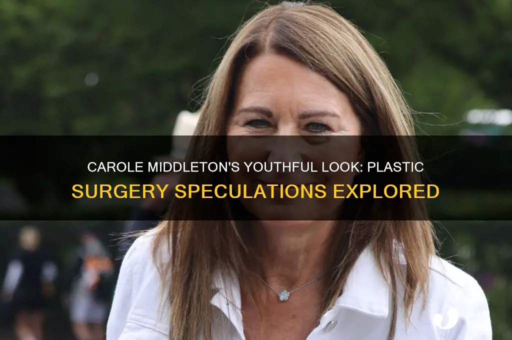 has carole middleton had plastic surgery