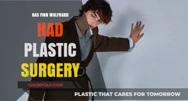 Finn Wolfhard Plastic Surgery: Fact-Checking the Rumors and Speculations