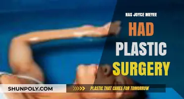 Joyce Meyer's Transformation: Plastic Surgery Speculations and Truths