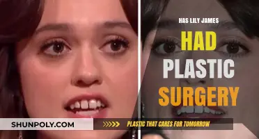 Has Lily James Had Plastic Surgery? Unveiling the Truth