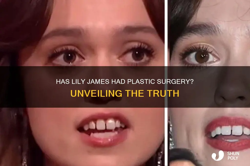 has lily james had plastic surgery