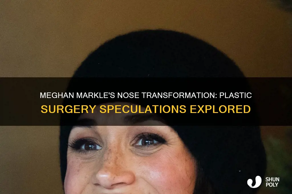 has meghan markle had plastic surgery on her nose