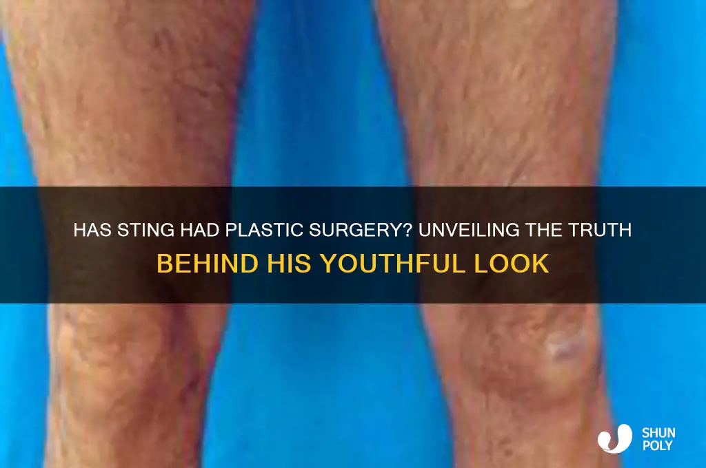 has sting had plastic surgery