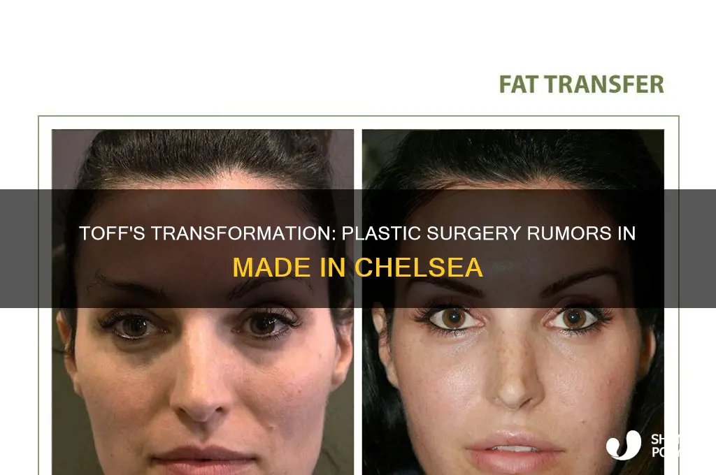 has toff from made in chelsea had plastic surgery