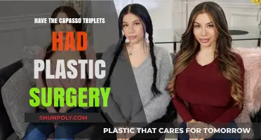 Capasso Triplets Plastic Surgery: Fact or Fiction? Unveiling the Truth