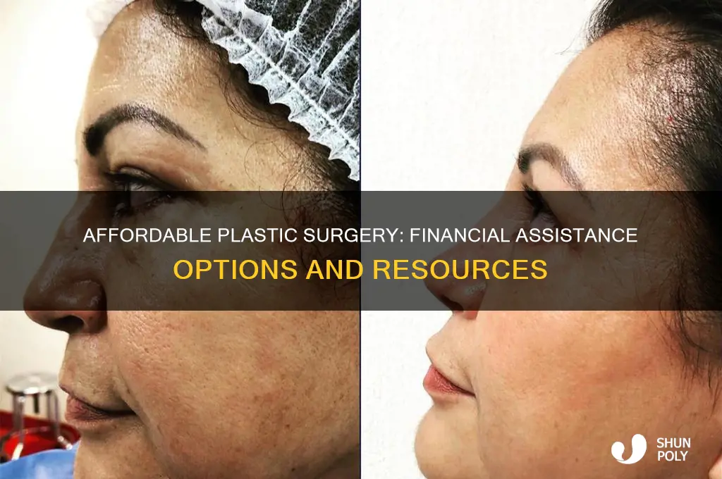 how can i get help paying for plastic surgery