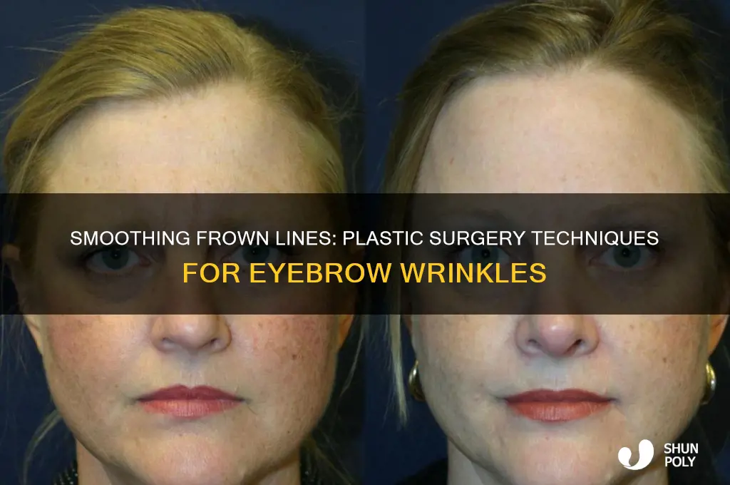 how do plastic surgeons fix the wrinkles between eyebrows