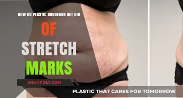 Effective Plastic Surgery Solutions for Removing Stretch Marks Permanently