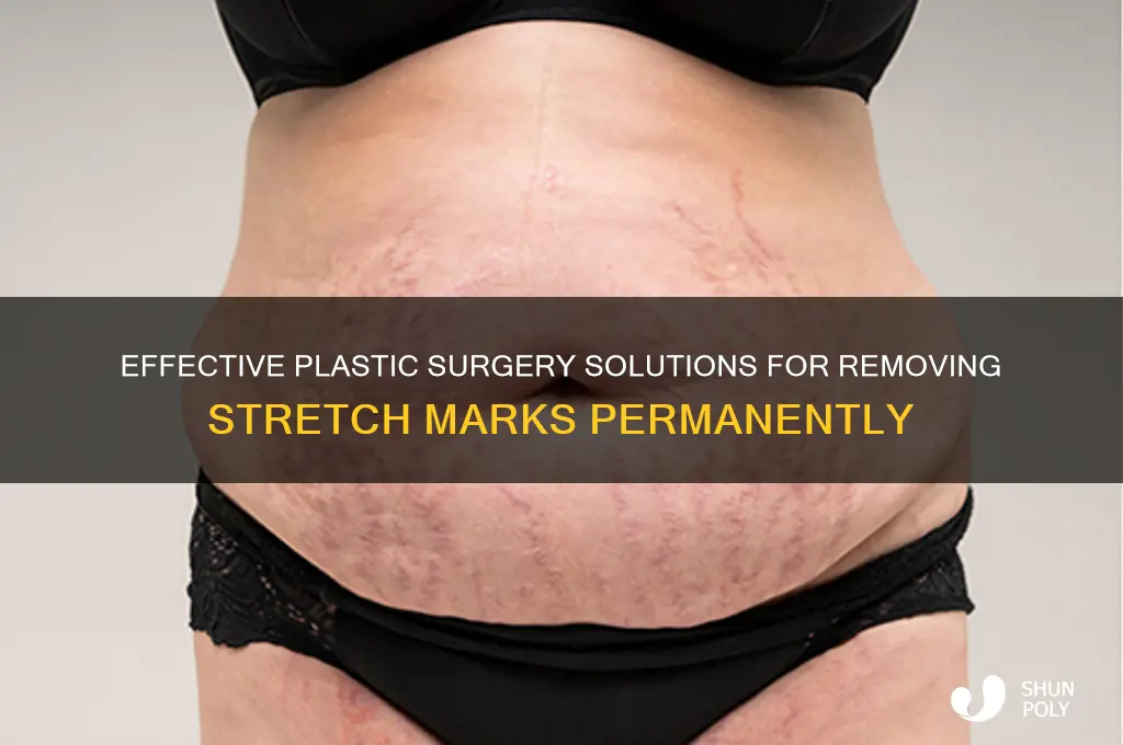 how do plastic surgeons get rid of stretch marks