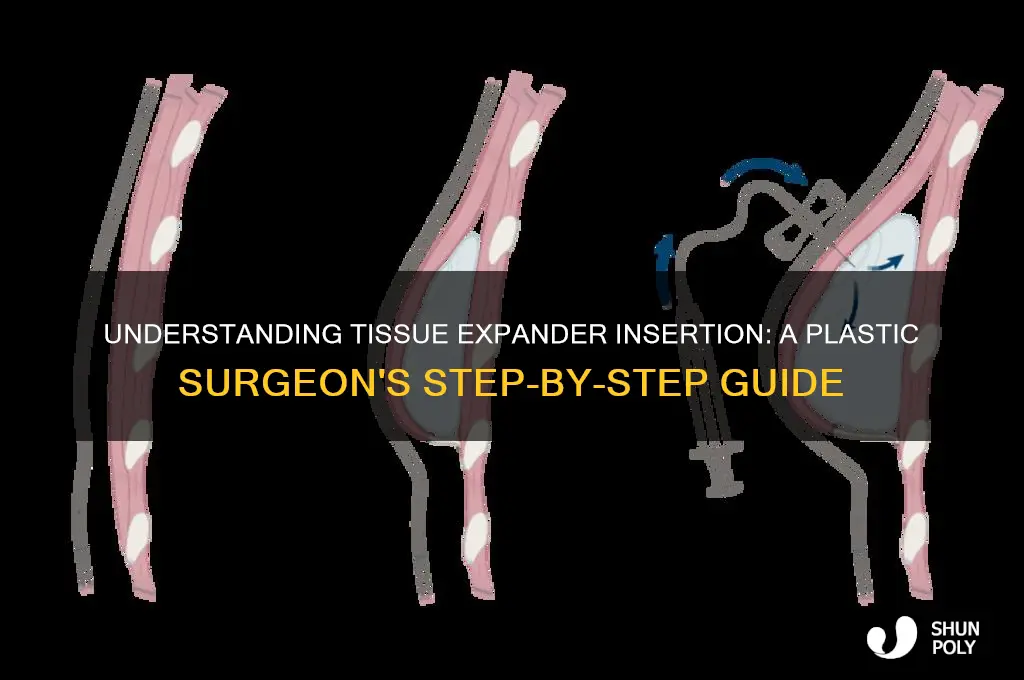how do plastic surgeons insert expanders