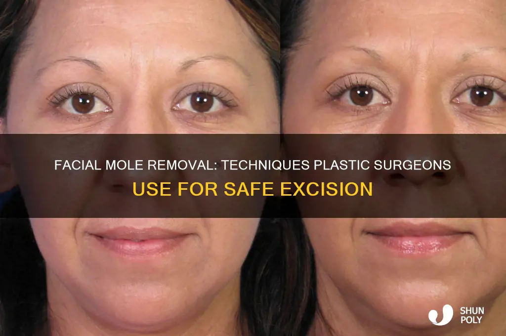 how do plastic surgeons remove facial moles