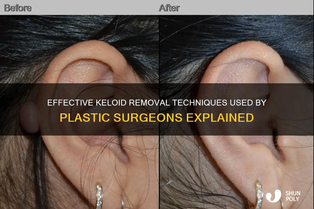how do plastic surgeons remove keloids