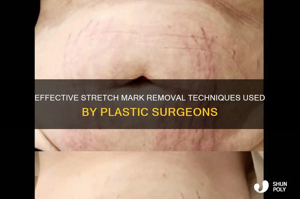how do plastic surgeons remove stretch marks
