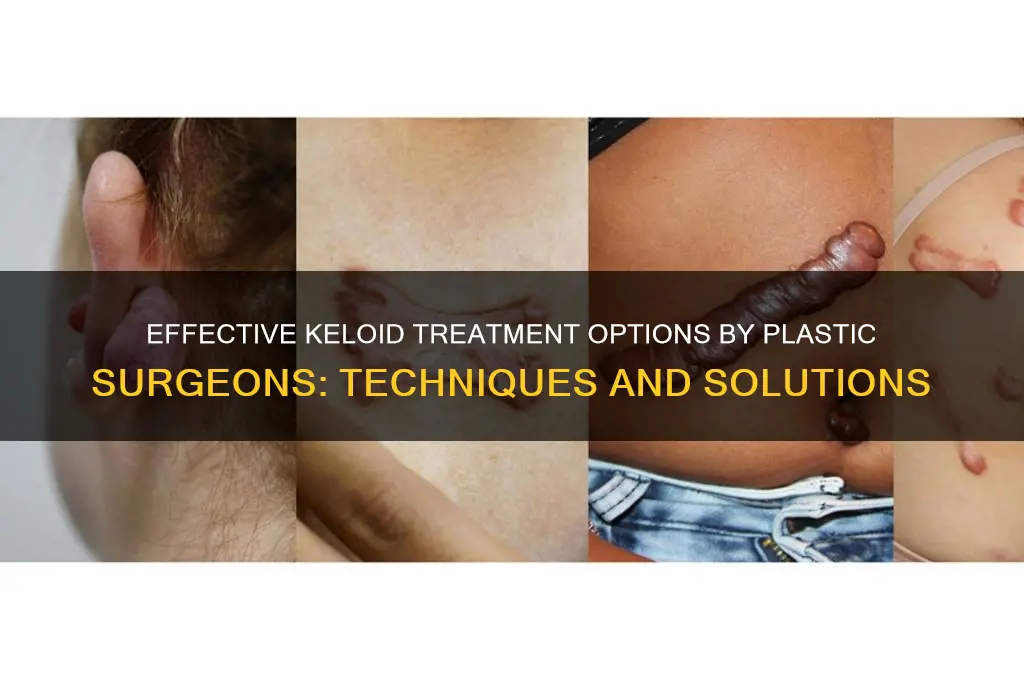 how do plastic surgeons treat keloids