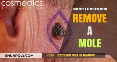Mole Removal by Plastic Surgeons: Techniques and Procedures Explained