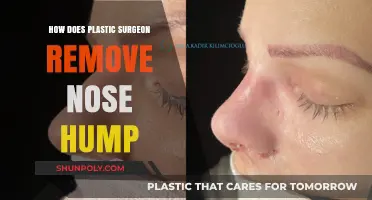 Removing a Nose Hump: Techniques and Process in Rhinoplasty Surgery
