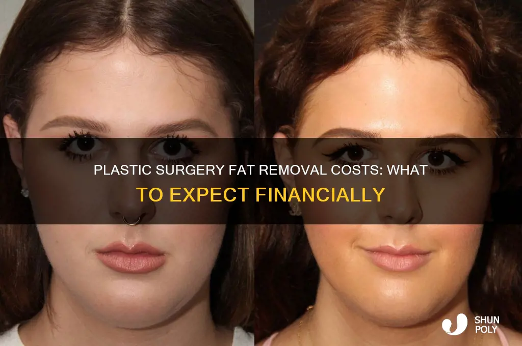 how expensive is plastic surgery to remove fat