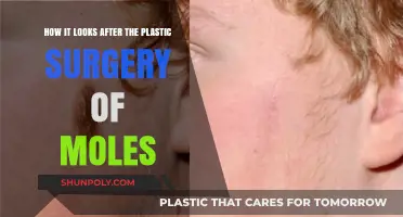 Post-Plastic Surgery Mole Removal: Appearance and Recovery Explained