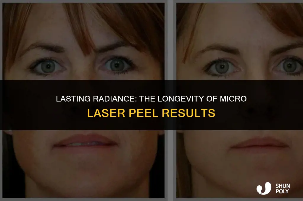 how long do micro laser peel results last myers plastic