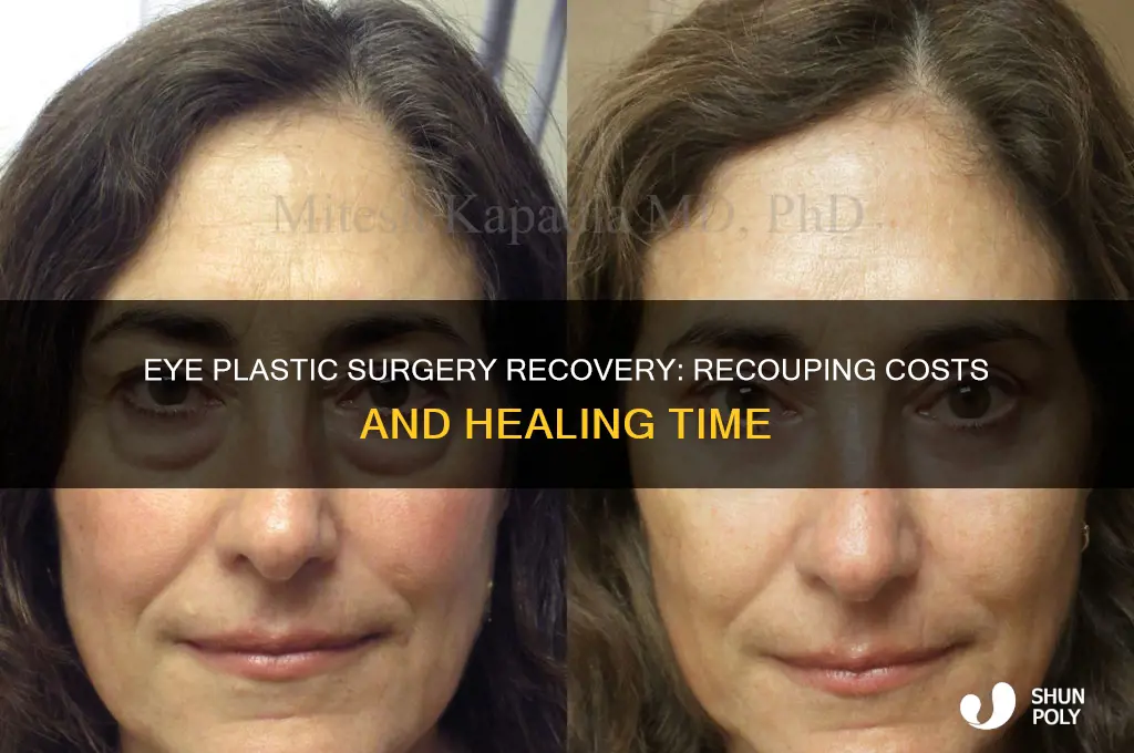 Eye Plastic Surgery Recovery: Recouping Costs And Healing Time | ShunPoly