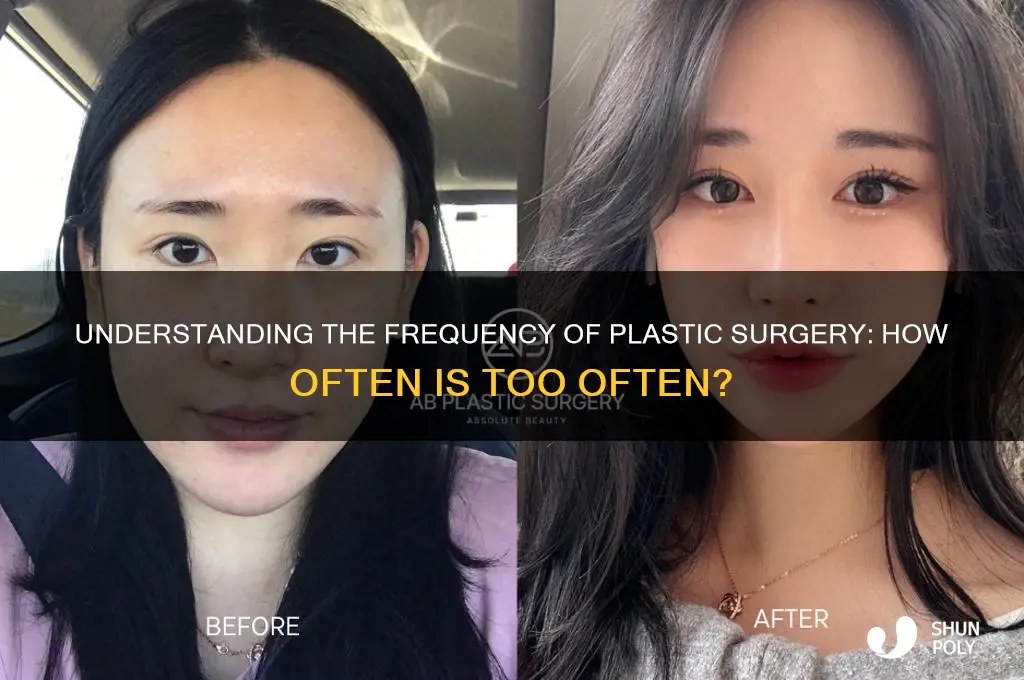 how many times do you have to get plastic surgery