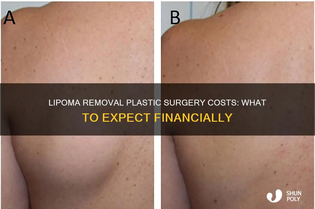 how much are lipoma removal plastic surgery