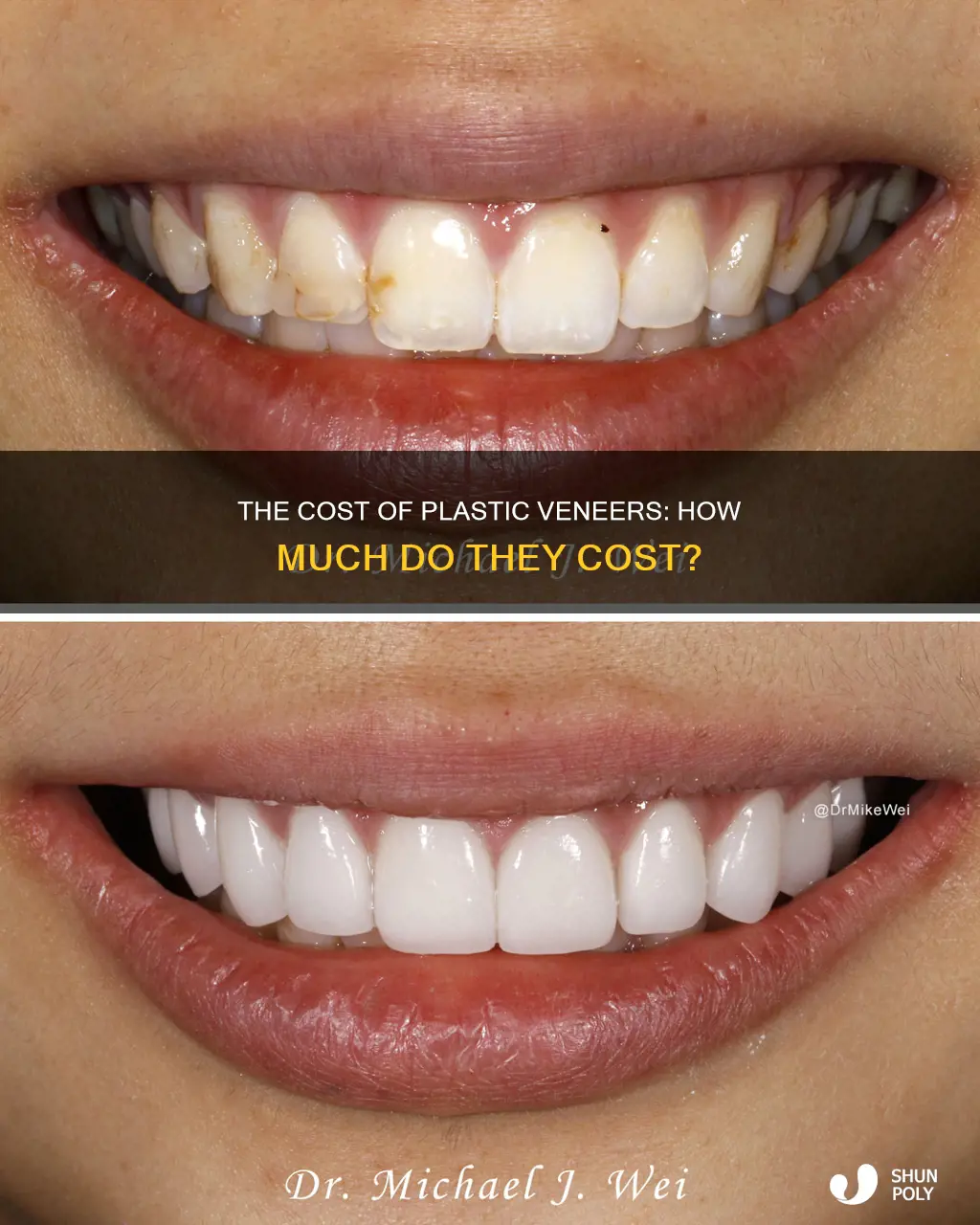 how much are plastic veneers