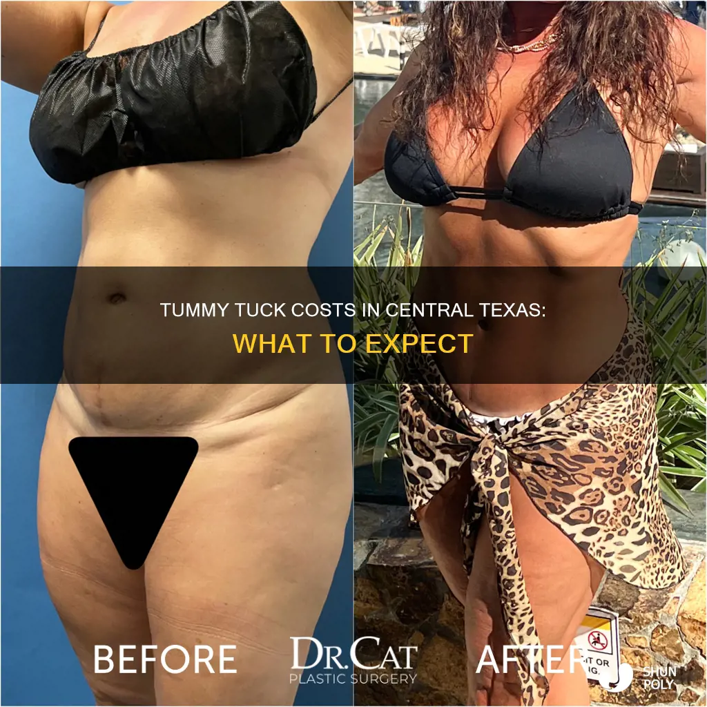 how much does a tummy tuck cost central texas plastic