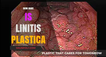 Exploring the Prevalence of Linitis Plastica: A Rare Condition
