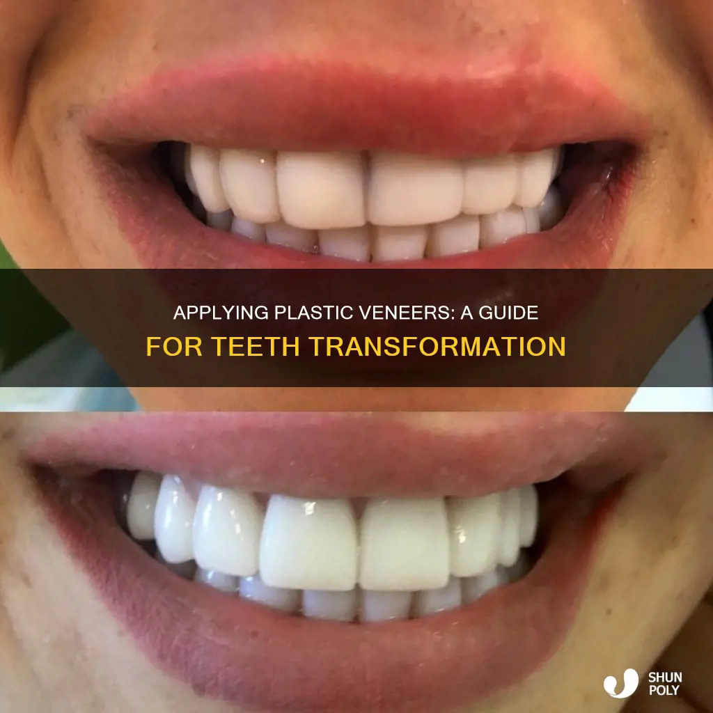 how to apply plastic veneers teeth