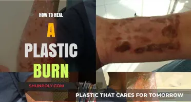 Healing Plastic Burns: Quick and Effective Home Remedies
