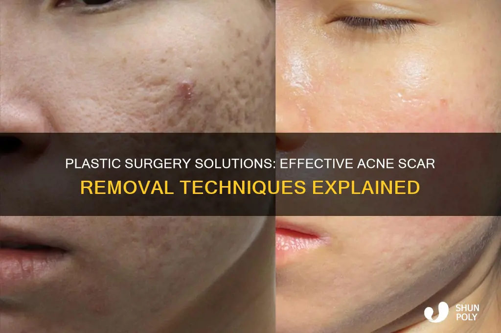 how to remove acne scars with plastic surgery